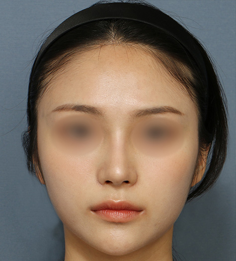 Before 10 Front