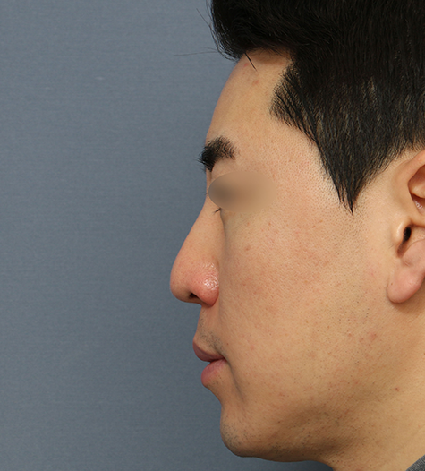 Before 2 Side