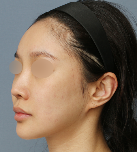 Before 10 45 Degrees