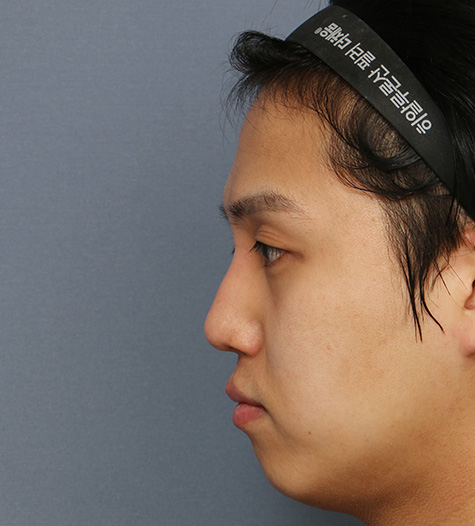 Before 4 Side