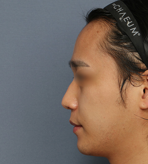Before 2 Side