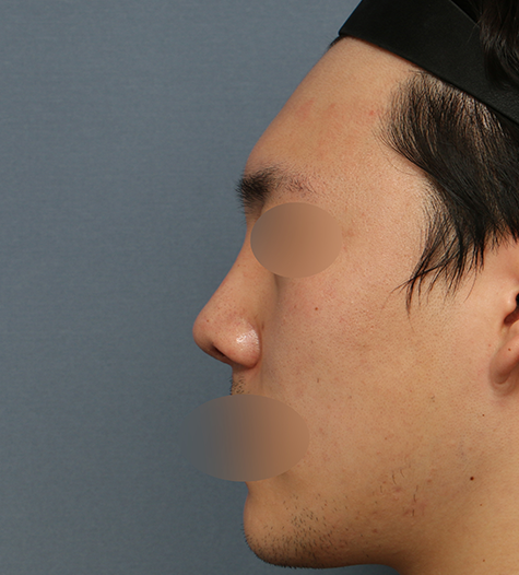 Before 3 Side