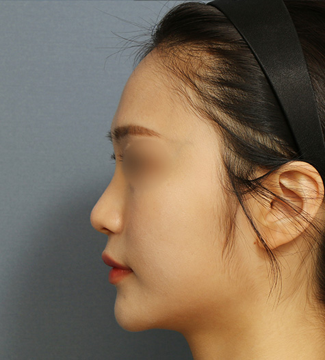 Before 10 Side