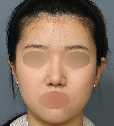 Before 3 Front