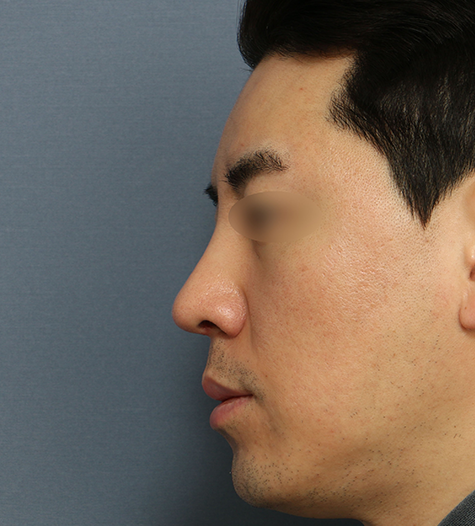 Before 2 Side