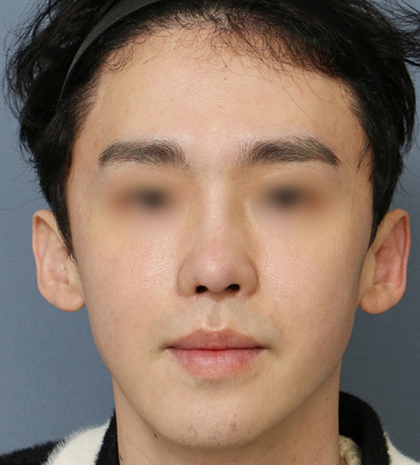 코수술
