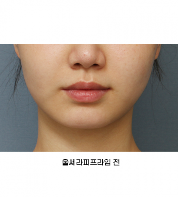 울쎄라피프라임