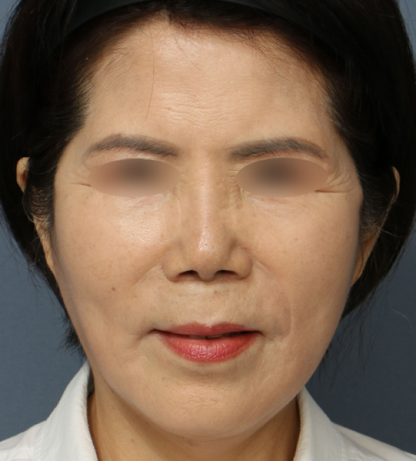 안면거상
