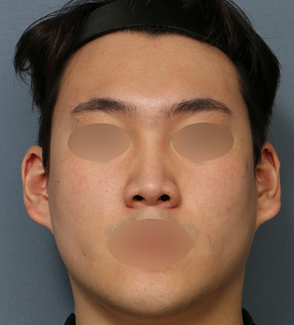 코수술