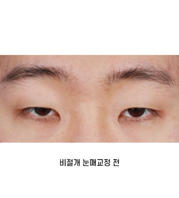 남자 눈성형