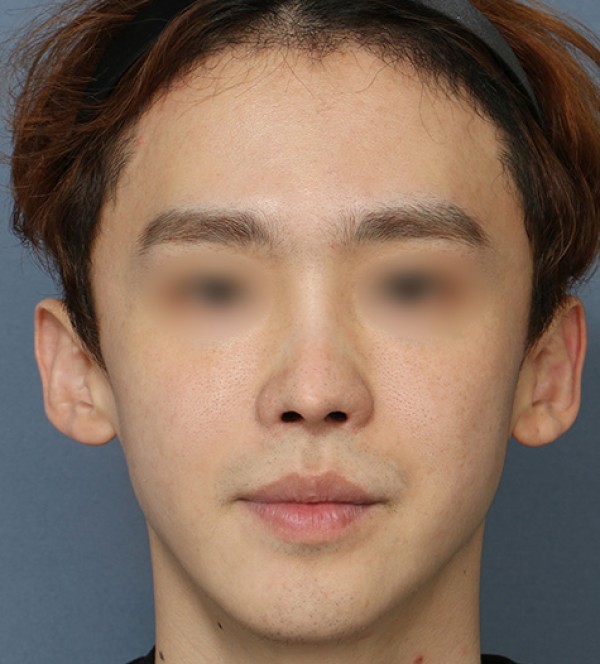 코수술
