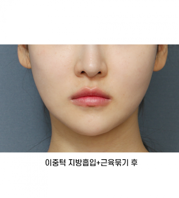 이중턱 지방흡입