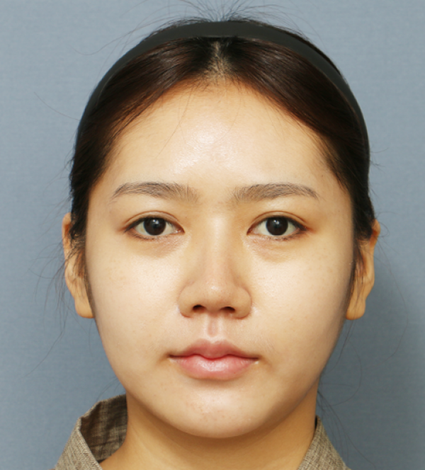 코재수술(자가늑)