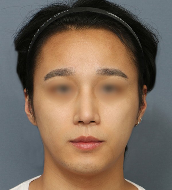 코수술