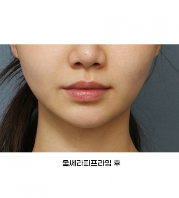 울쎄라피프라임