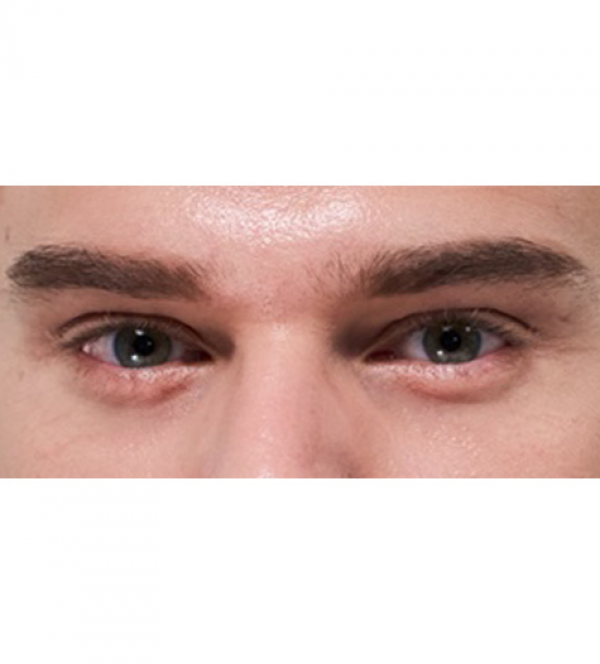 눈밑지방재배치