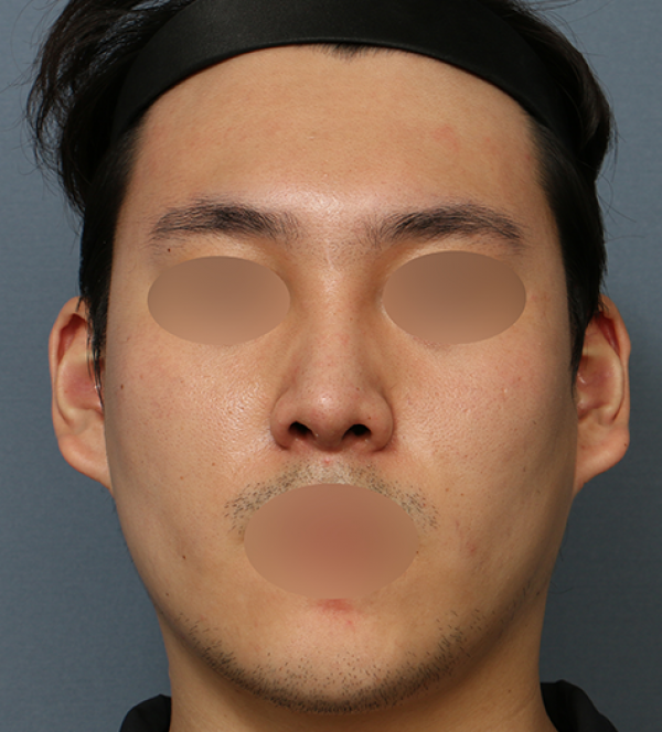 코수술