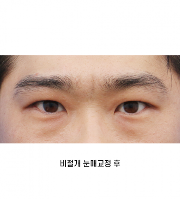 남자 눈성형