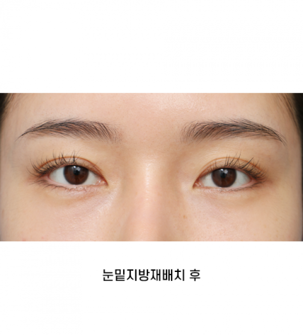 눈밑지방재배치