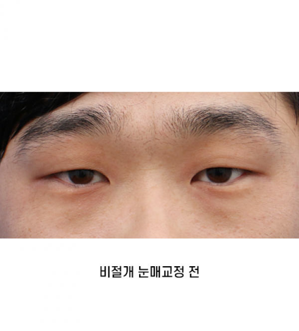 남자 눈성형