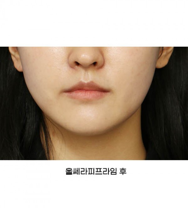 울쎄라피프라임