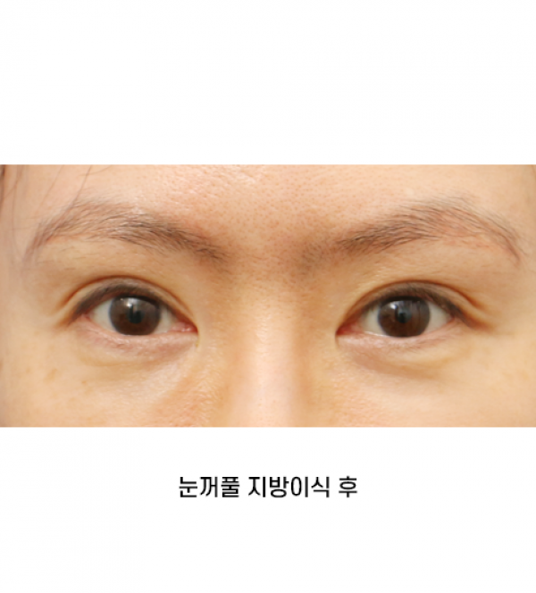 눈꺼풀 지방이식