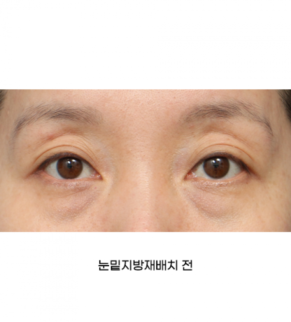 눈밑지방재배치