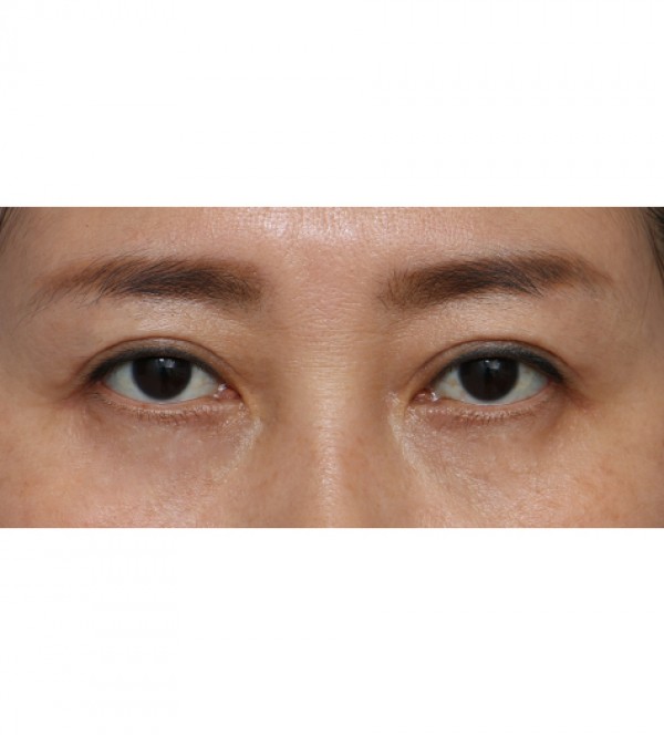 상안검+눈매교정