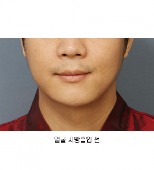 얼굴 지방흡입
