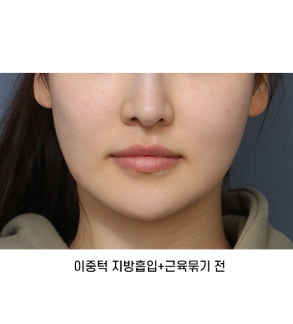 이중턱 지방흡입