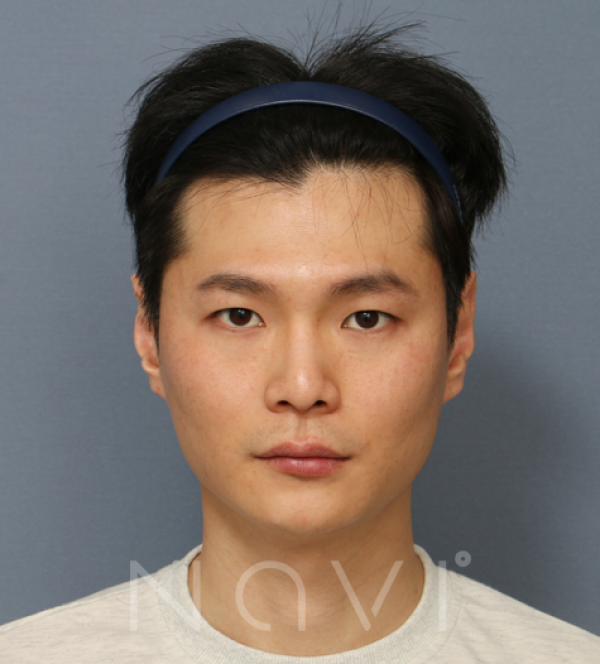 코성형