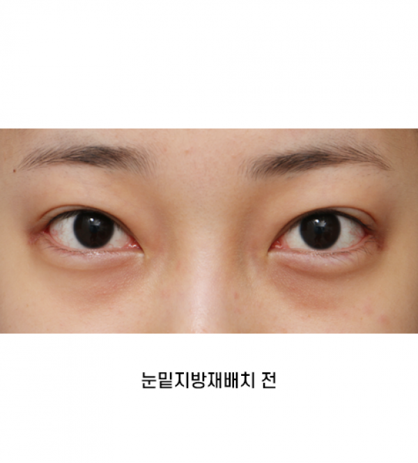 눈밑지방재배치
