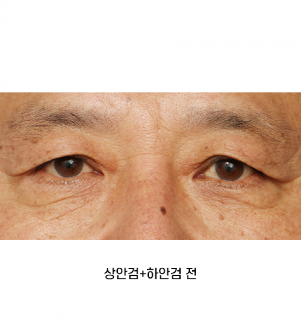 상안검+하안검