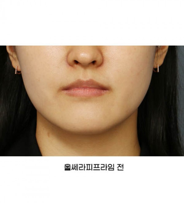 울쎄라피프라임