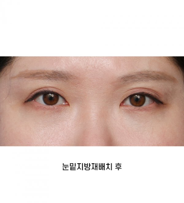 눈밑지방재배치