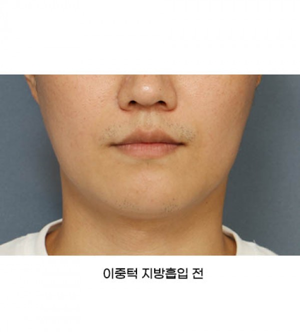 얼굴 지방흡입