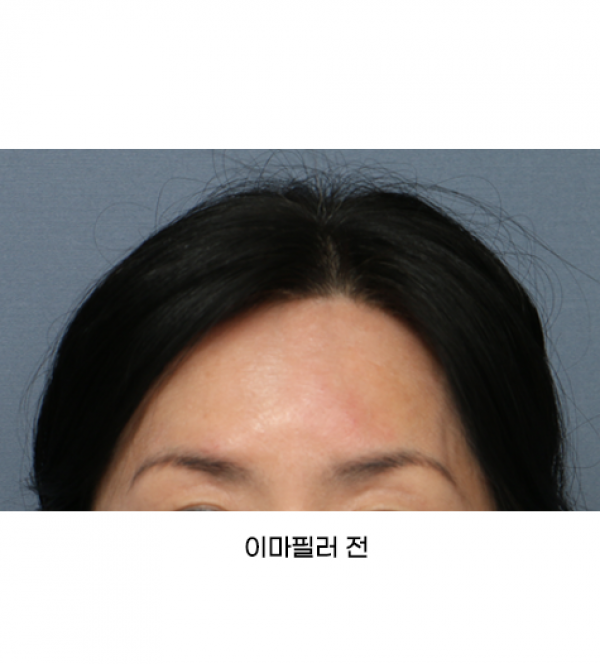 이마필러
